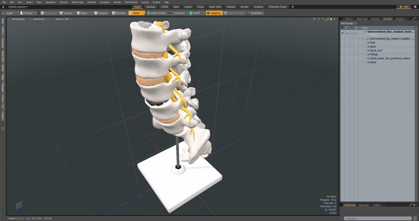 3D Intervertebral Disc Implant Installed on Spine 2 model