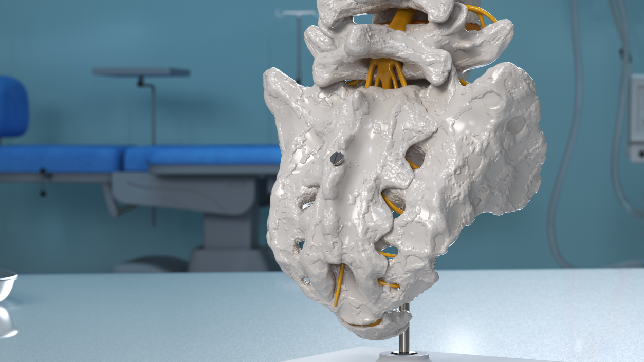 3D Intervertebral Disc Implant Installed on Spine 2 model