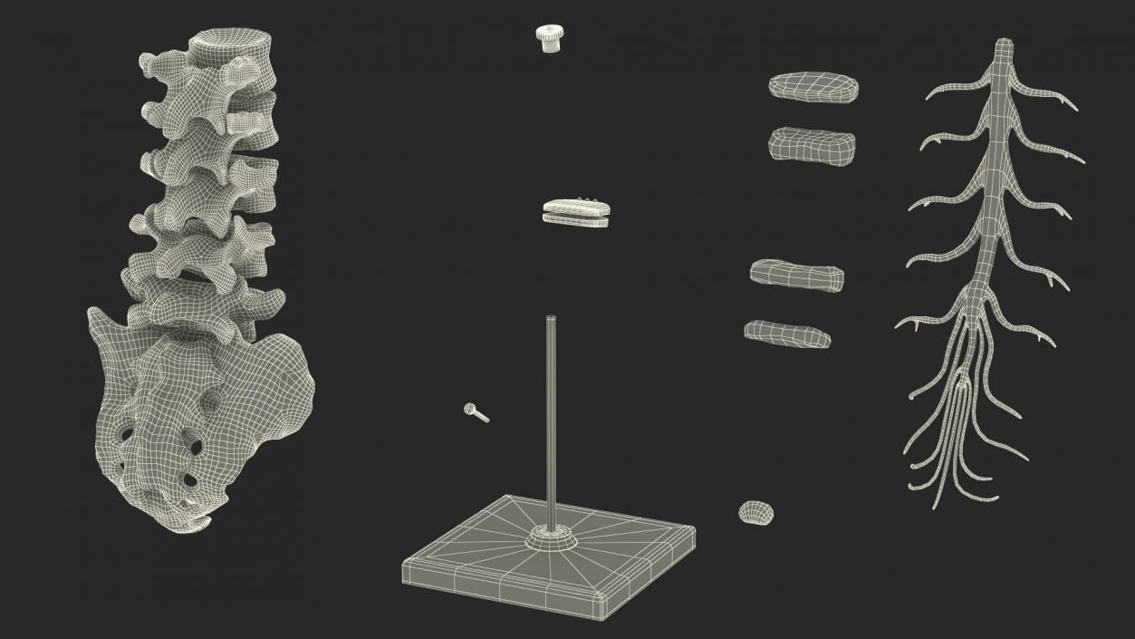 3D Intervertebral Disc Implant Installed on Spine 2 model