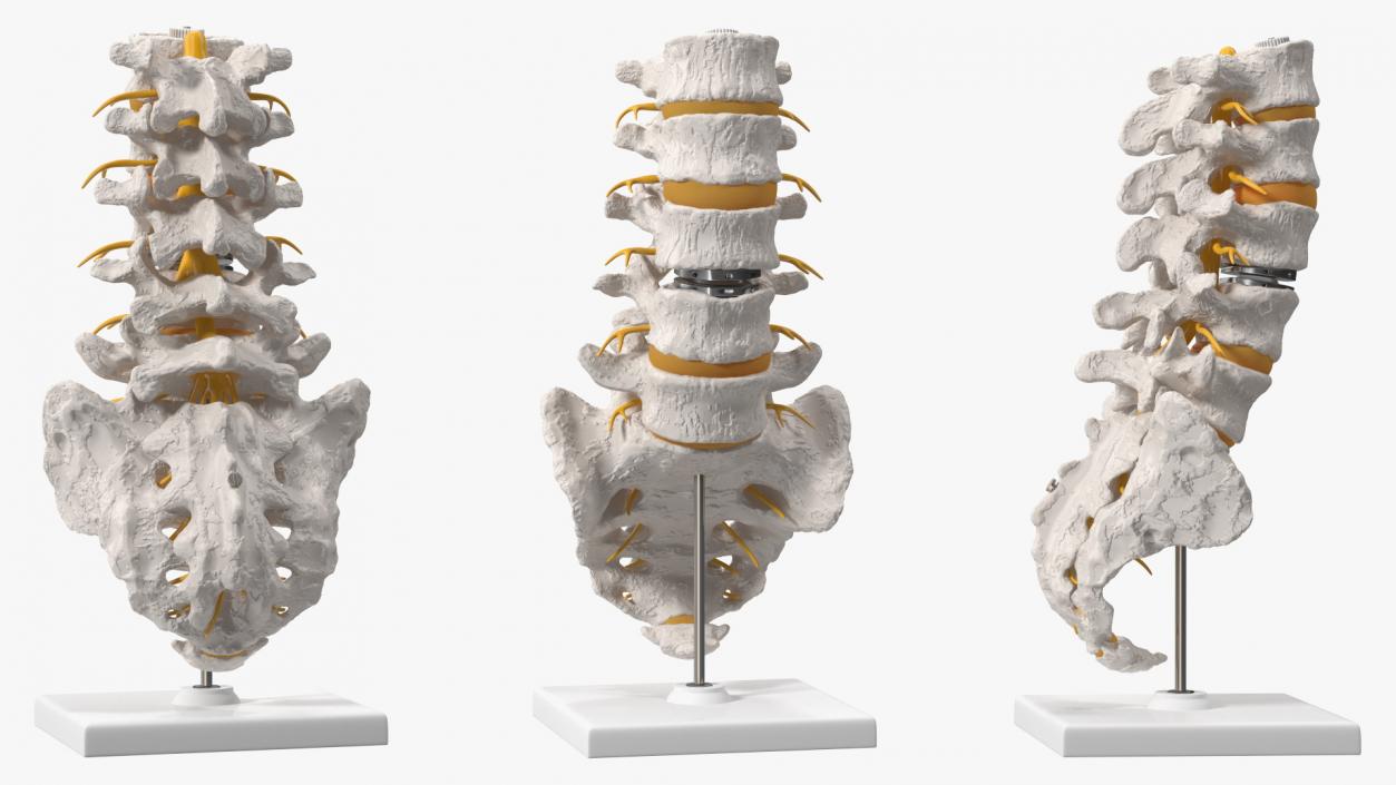 3D Intervertebral Disc Implant Installed on Spine 2 model