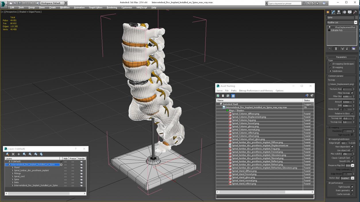 3D Intervertebral Disc Implant Installed on Spine 2 model