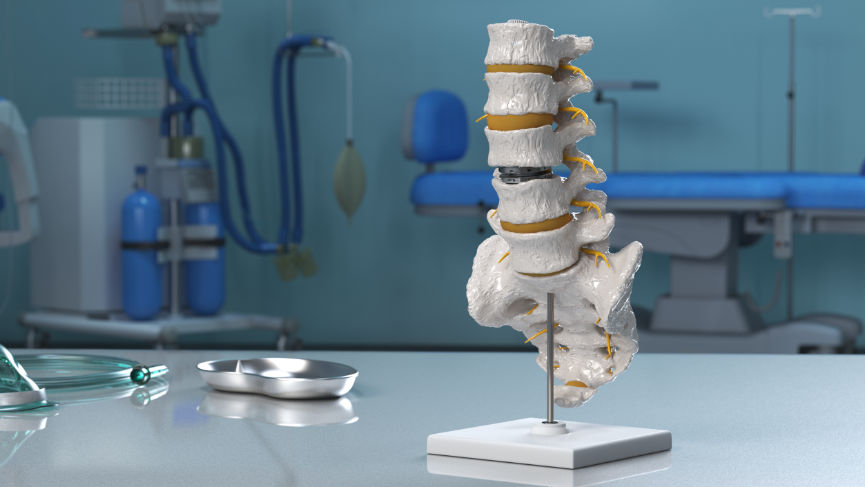 3D Intervertebral Disc Implant Installed on Spine 2 model