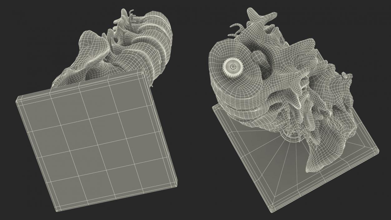 3D Intervertebral Disc Implant Installed on Spine 2 model