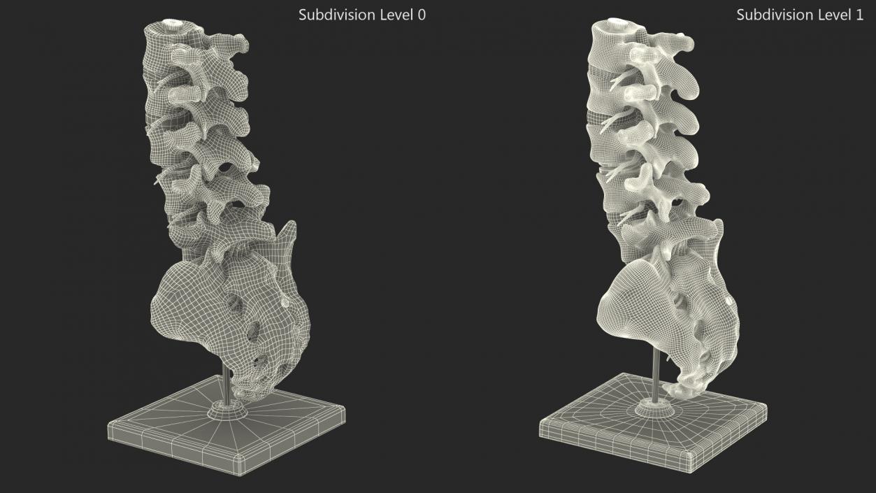 3D Intervertebral Disc Implant Installed on Spine 2 model