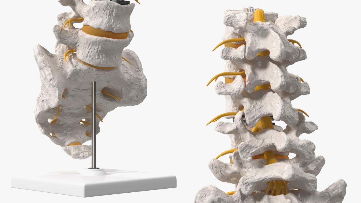 3D Intervertebral Disc Implant Installed on Spine 2 model