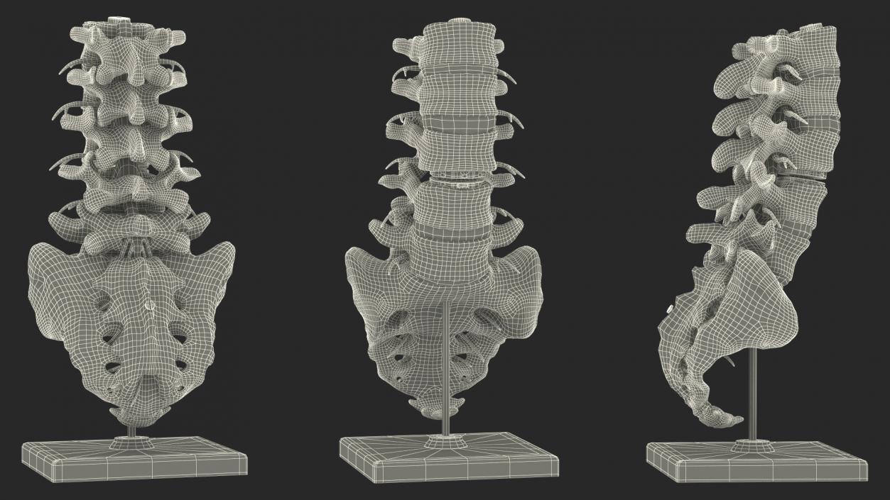 3D Intervertebral Disc Implant Installed on Spine 2 model