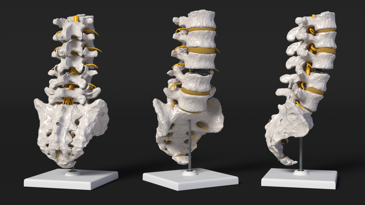 3D Intervertebral Disc Implant Installed on Spine 2 model