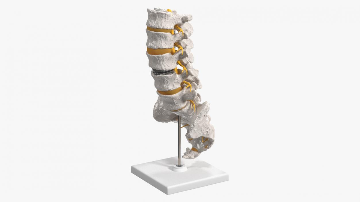 3D Intervertebral Disc Implant Installed on Spine 2 model