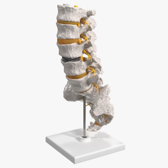 3D Intervertebral Disc Implant Installed on Spine 2 model