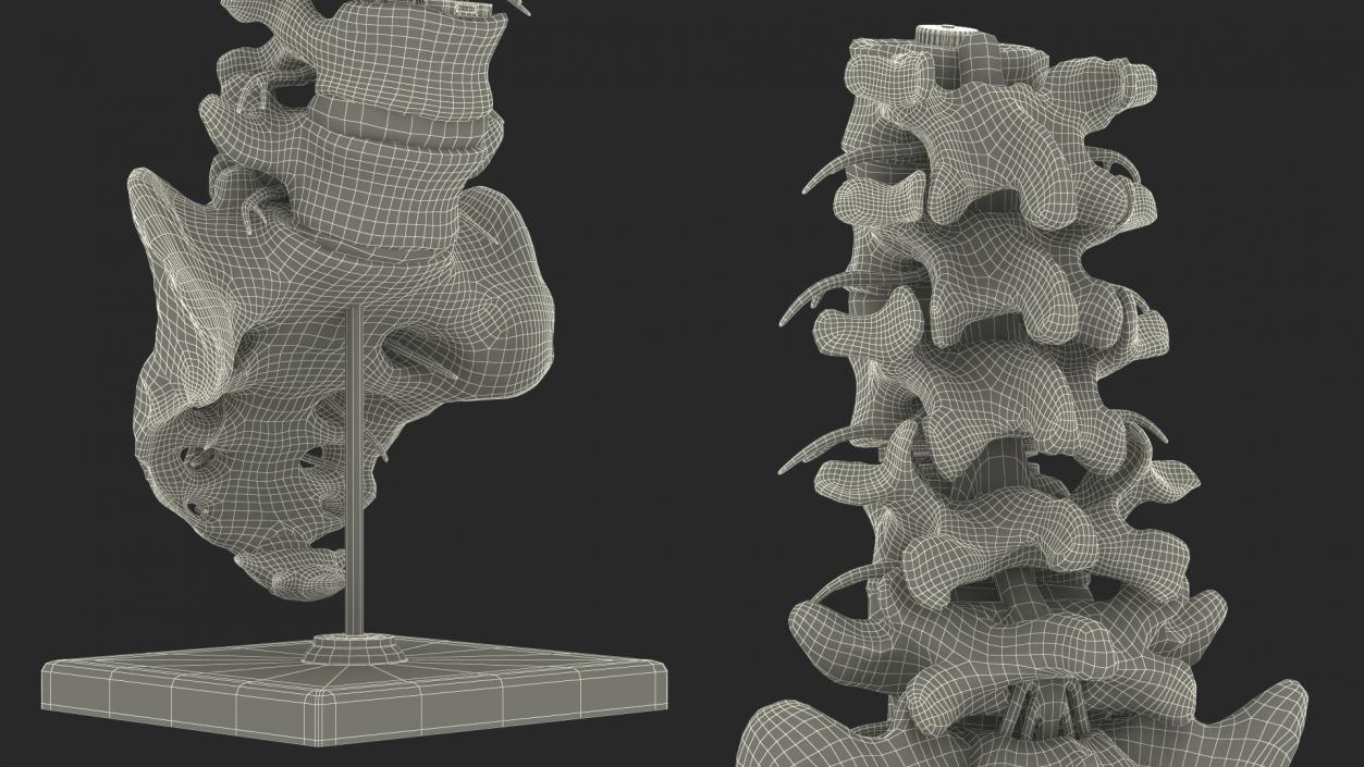 3D Intervertebral Disc Implant Installed on Spine 2 model