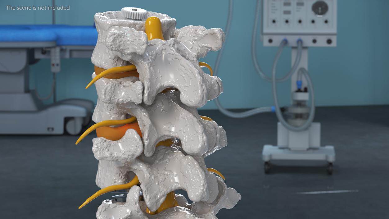 3D Intervertebral Disc Implant Installed on Spine 2 model