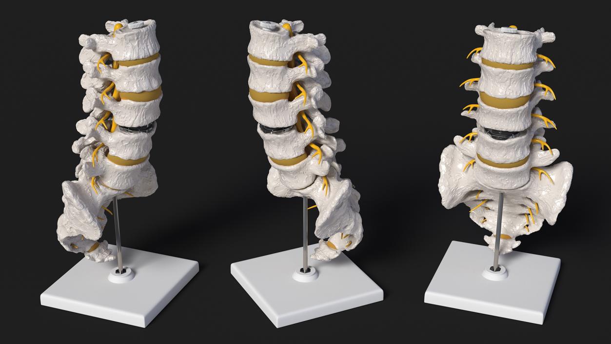 3D Intervertebral Disc Implant Installed on Spine 2 model