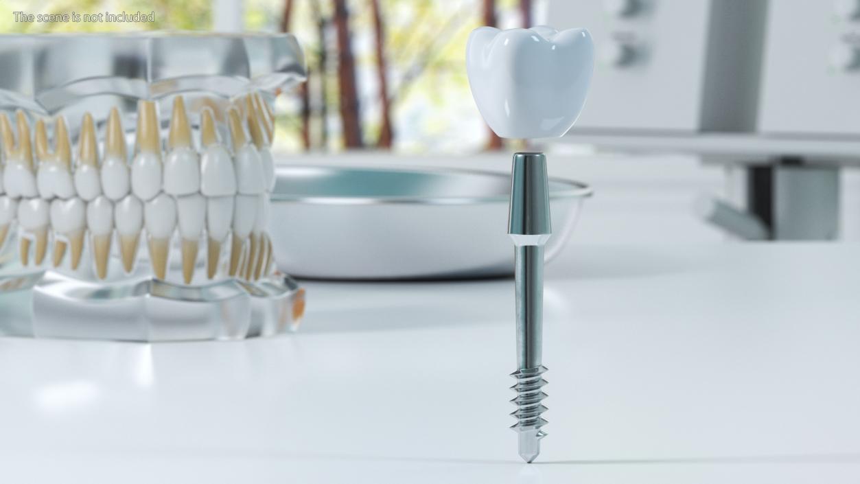 3D Dental Implants Collection