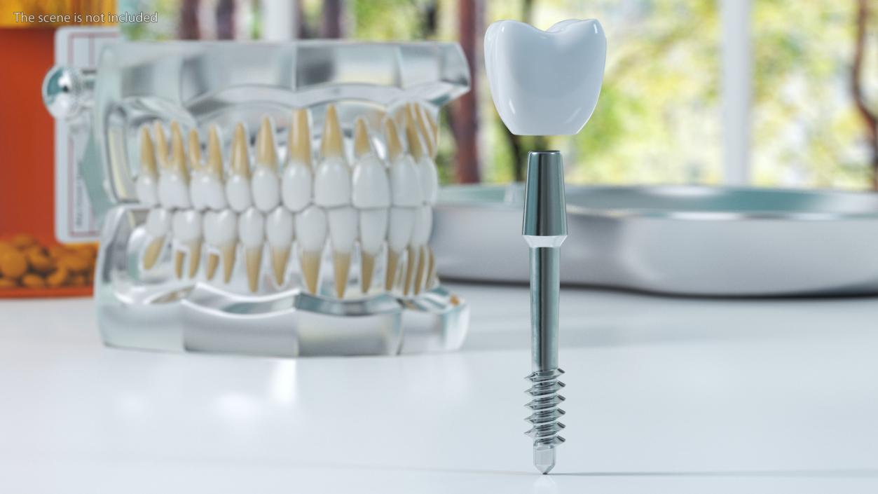 3D Dental Implants Collection