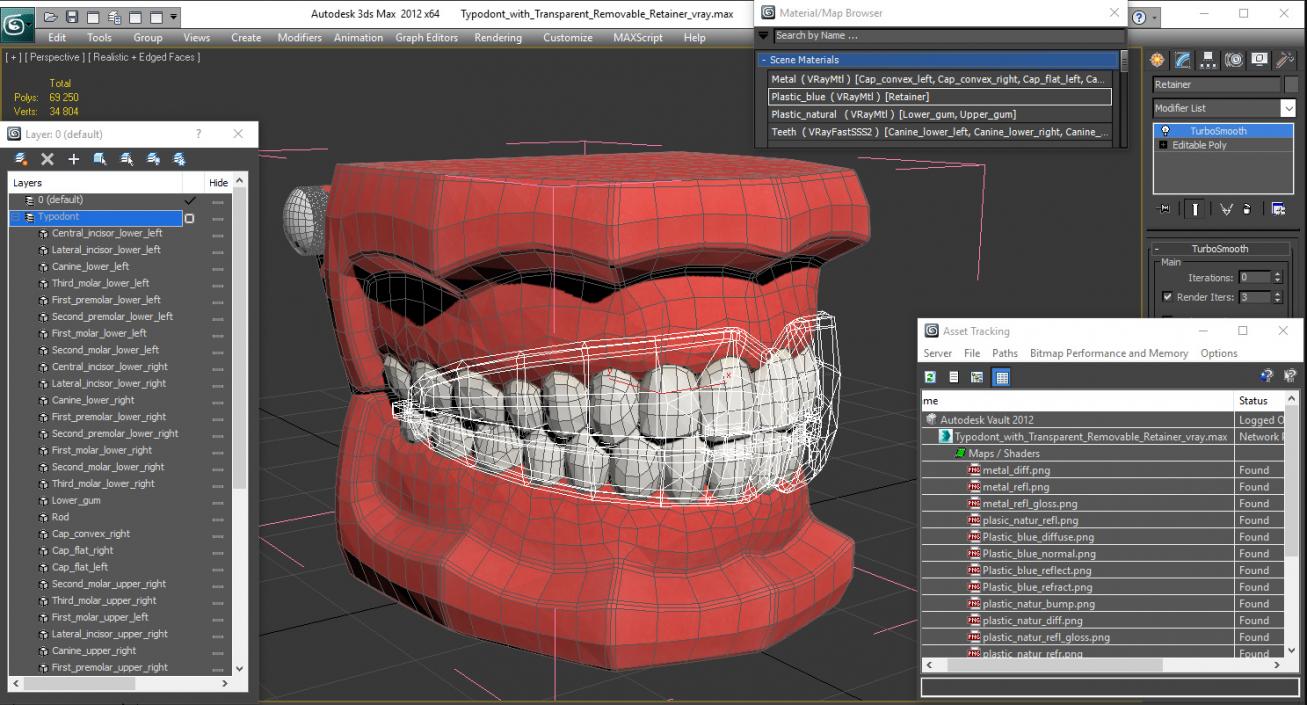 Typodont with Transparent Removable Retainer 3D model