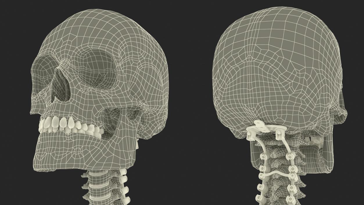 3D model Bone Skull and Cervical Spine Fixation 2