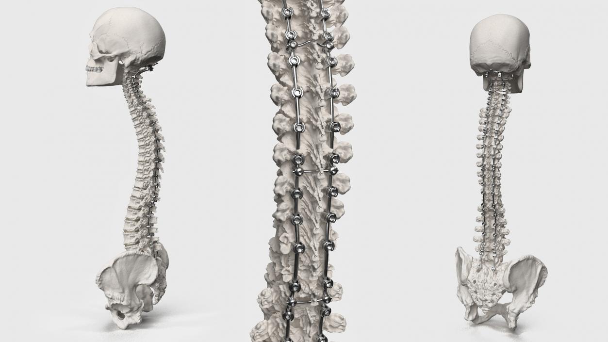 3D model Bone Skull and Cervical Spine Fixation 2