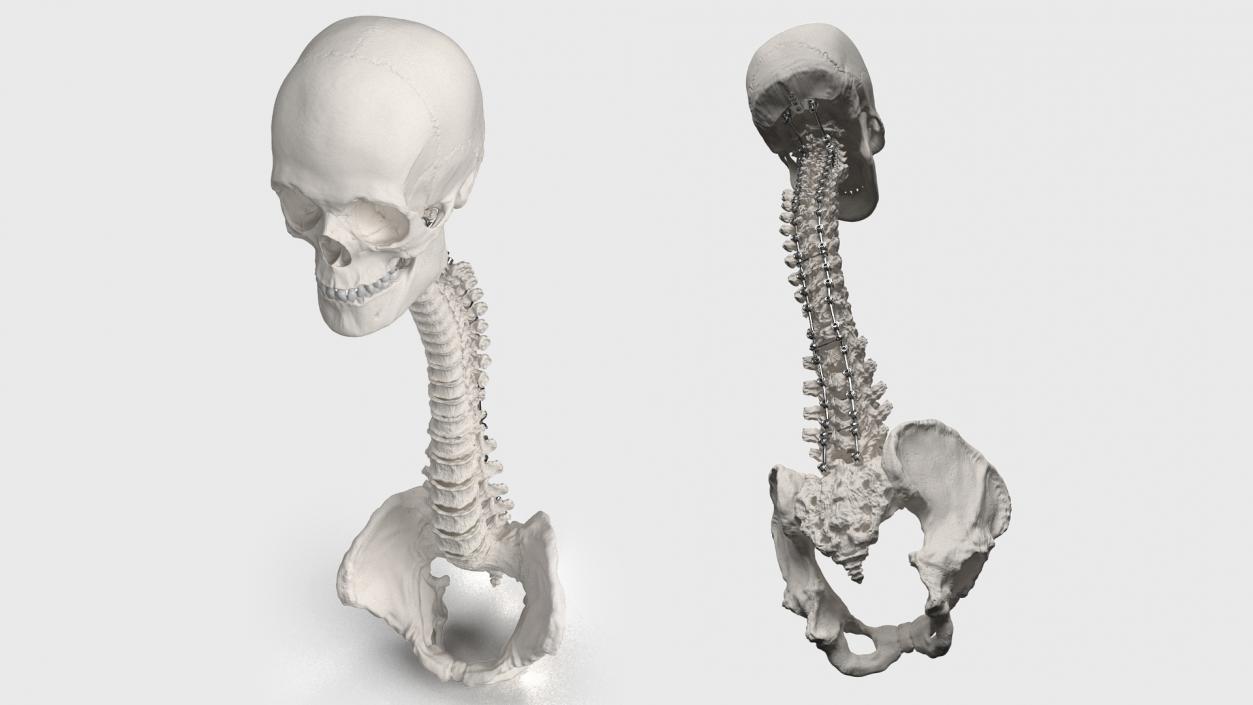 3D model Bone Skull and Cervical Spine Fixation 2