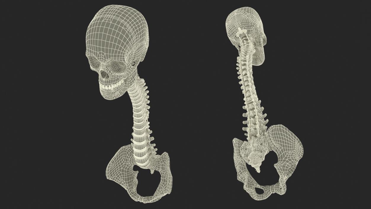 3D model Bone Skull and Cervical Spine Fixation 2