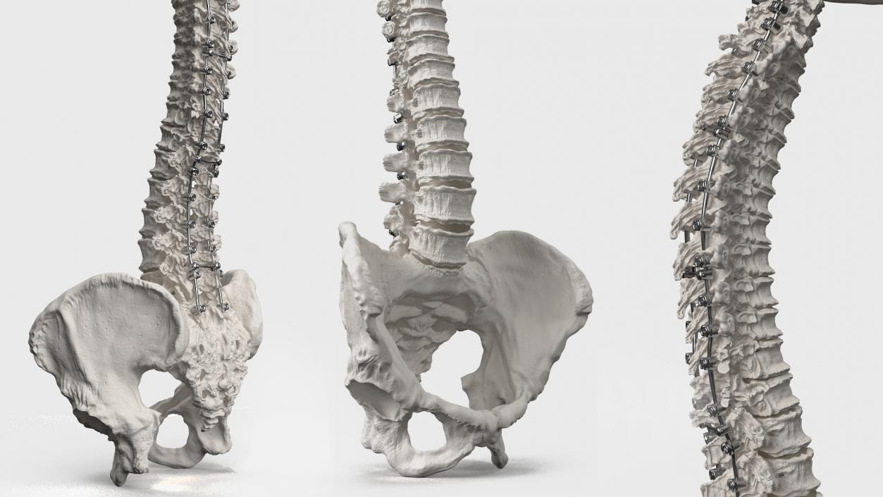 3D model Bone Skull and Cervical Spine Fixation 2