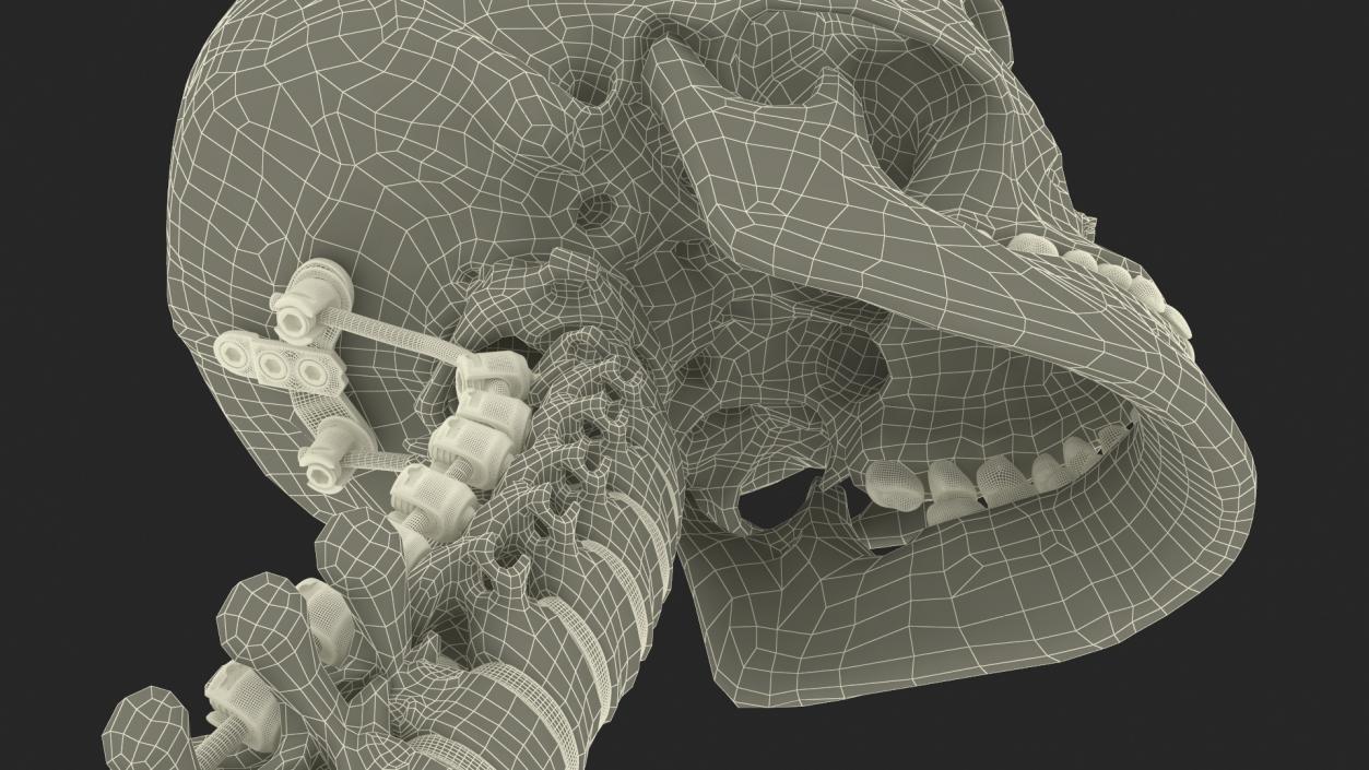 3D model Bone Skull and Cervical Spine Fixation 2