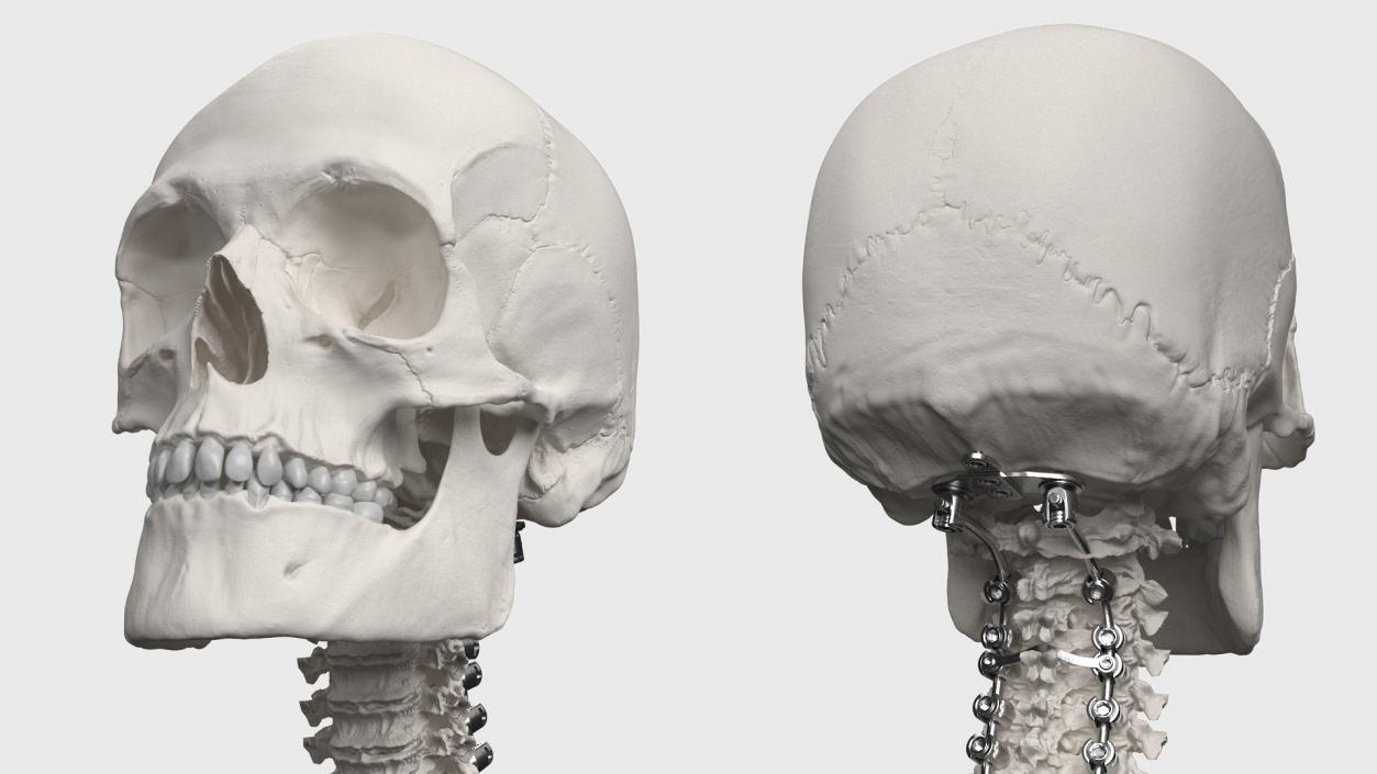 3D model Bone Skull and Cervical Spine Fixation 2