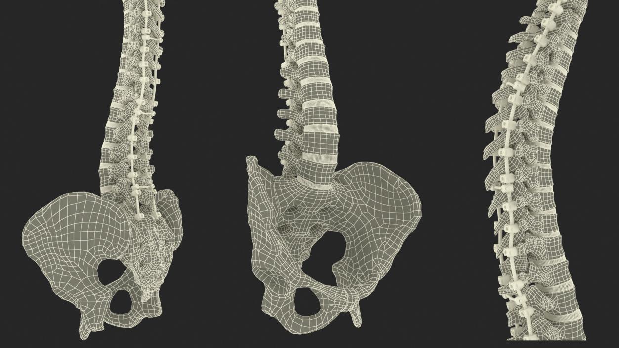 3D model Bone Skull and Cervical Spine Fixation 2