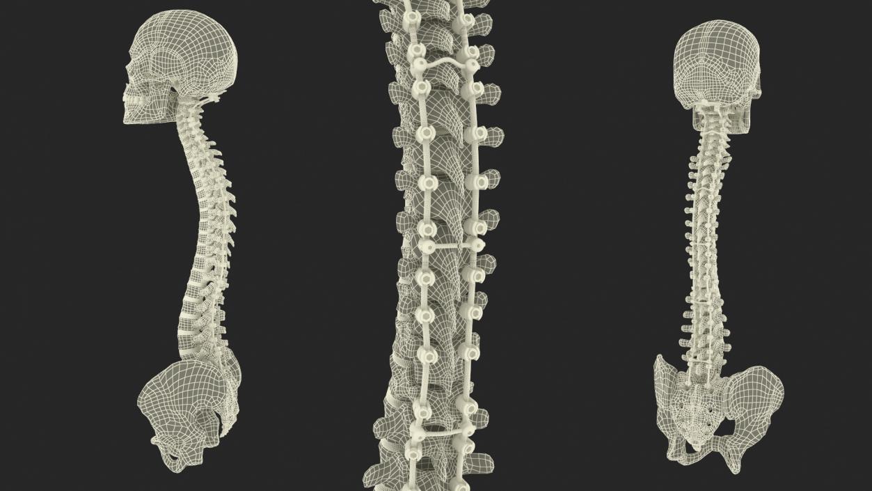 3D model Bone Skull and Cervical Spine Fixation 2