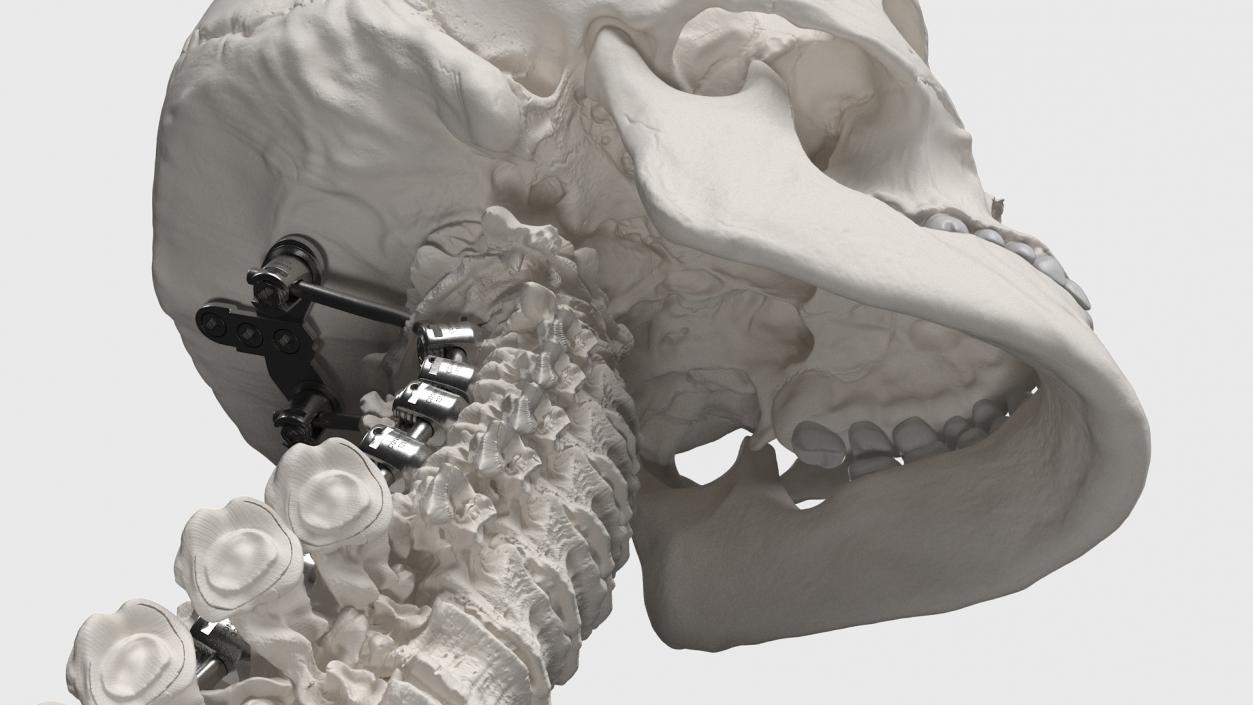 3D model Bone Skull and Cervical Spine Fixation 2