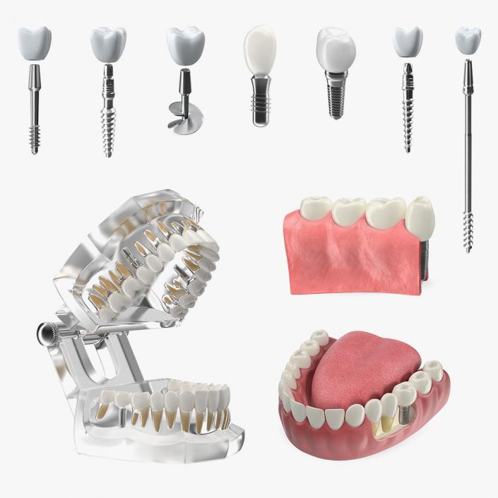 Tooth Implants Collection 4 3D