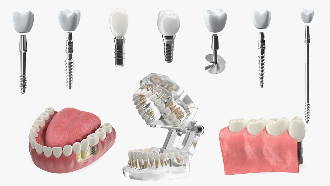 Tooth Implants Collection 4 3D