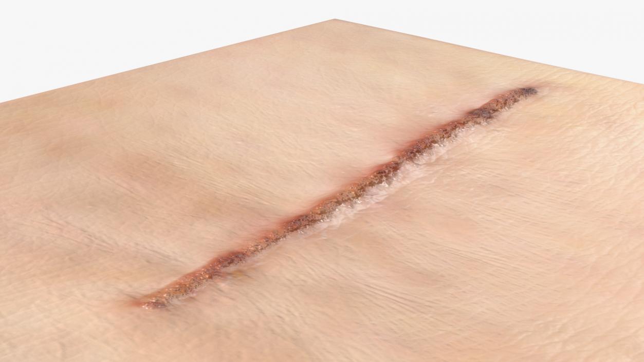 Medical Suture Closed on Skin 3D model