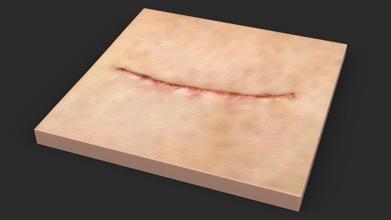 Medical Suture Closed on Skin 3D model