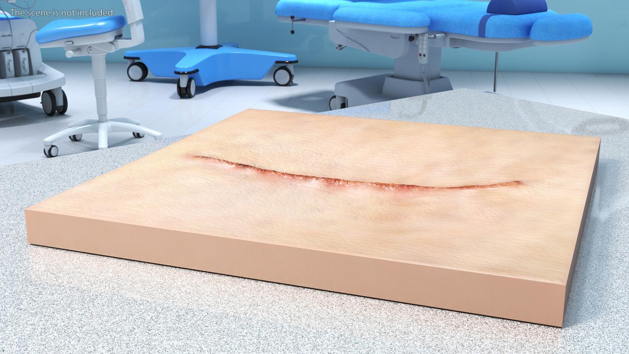 Medical Suture Closed on Skin 3D model