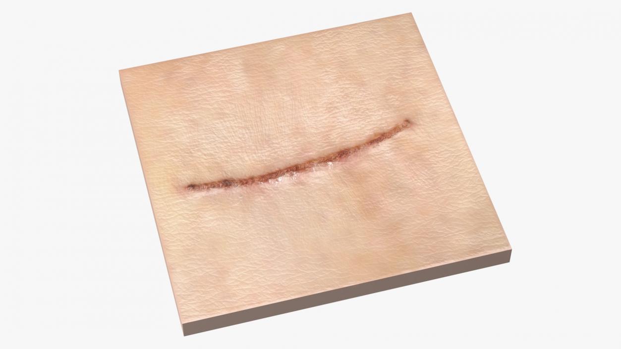 Medical Suture Closed on Skin 3D model