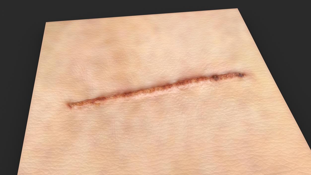 Medical Suture Closed on Skin 3D model