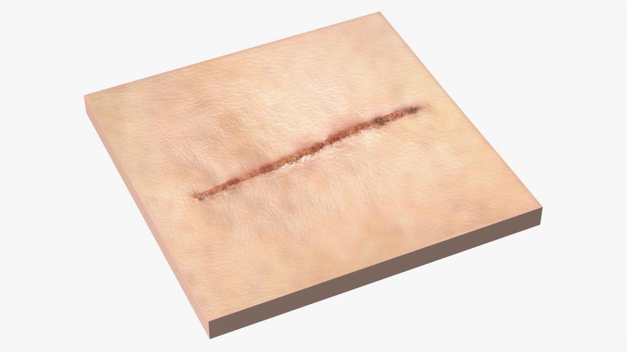 Medical Suture Closed on Skin 3D model