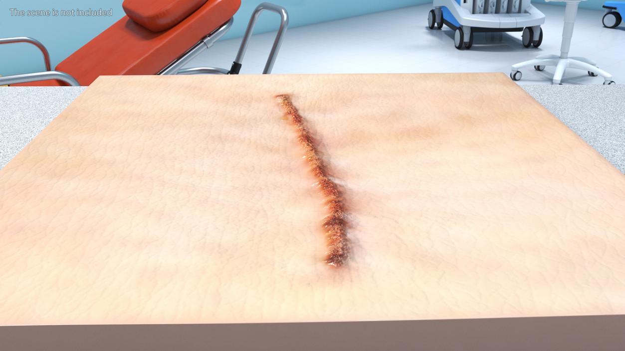 Medical Suture Closed on Skin 3D model