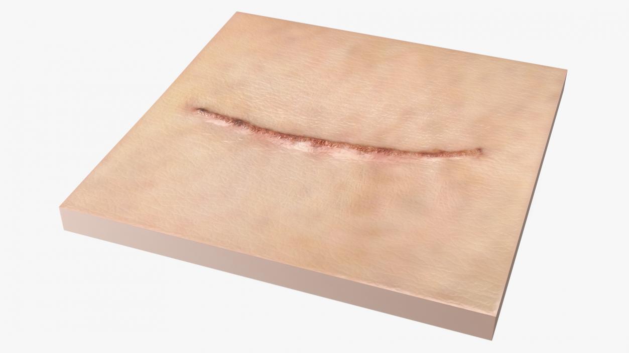 Medical Suture Closed on Skin 3D model