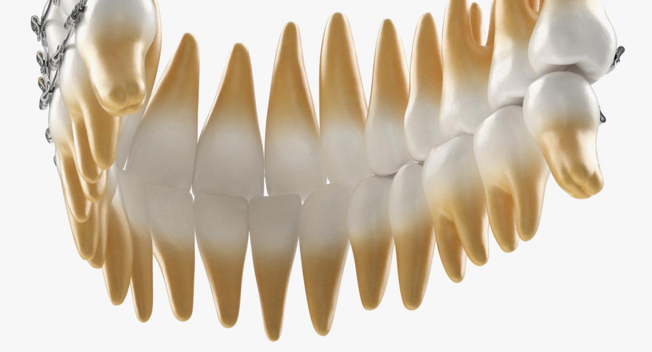 3D Teeth with Braces Model model