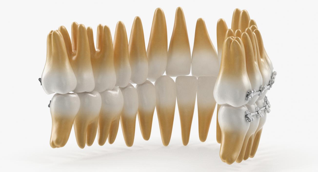 3D Teeth with Braces Model model