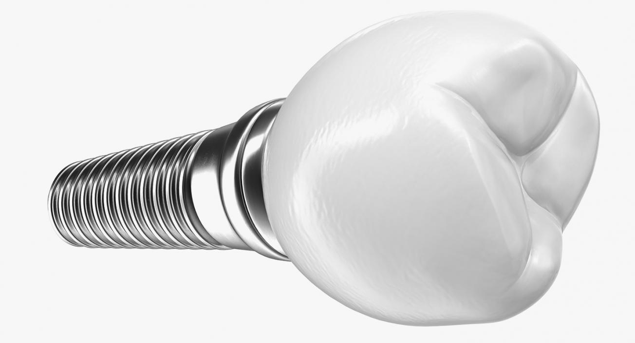 3D model Tooth Dental Implant