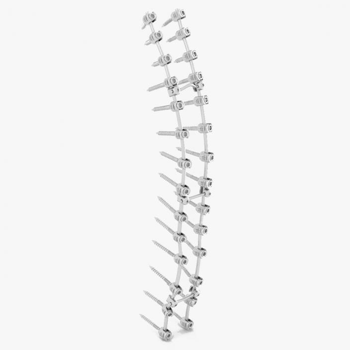 Thoracic Spine Fixation System 2 3D