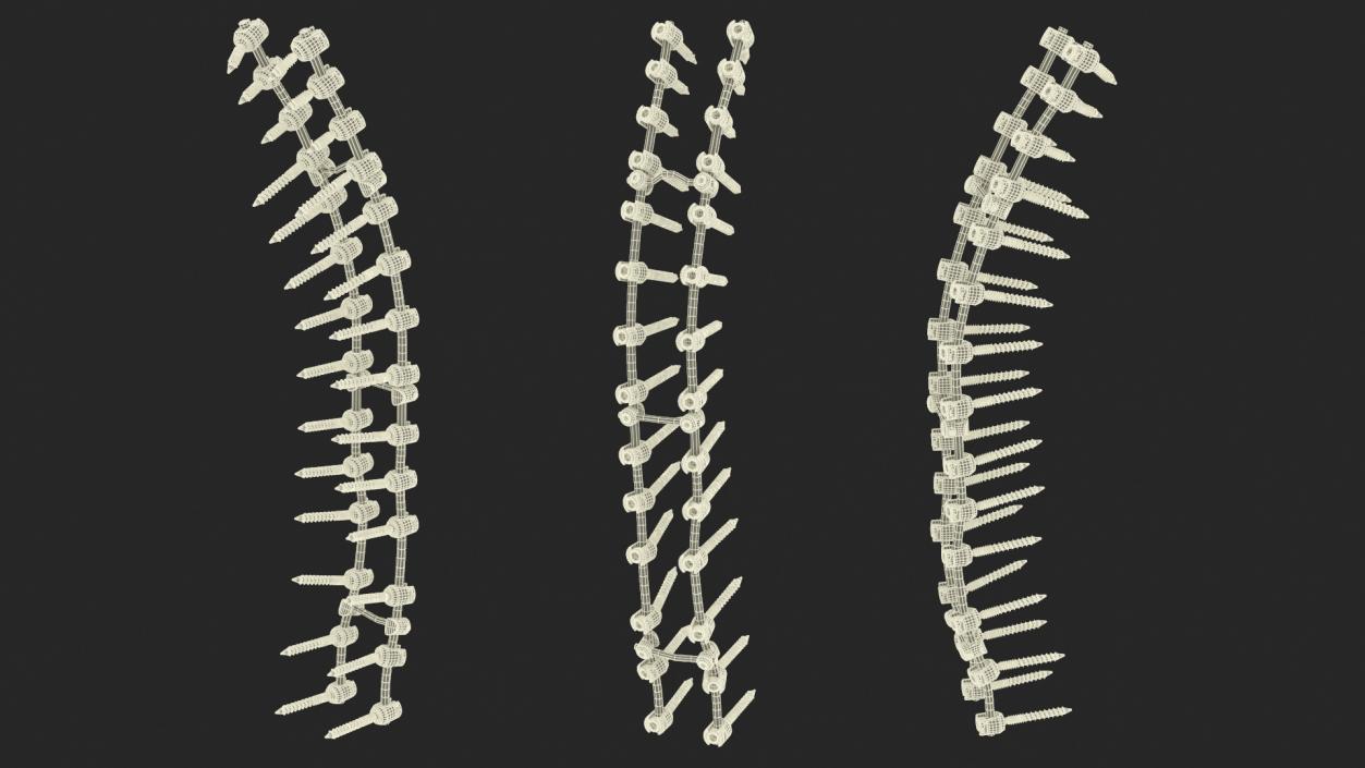 Thoracic Spine Fixation System 2 3D