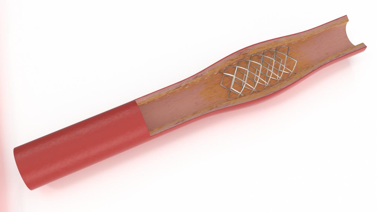 3D model Stents with Artery 2