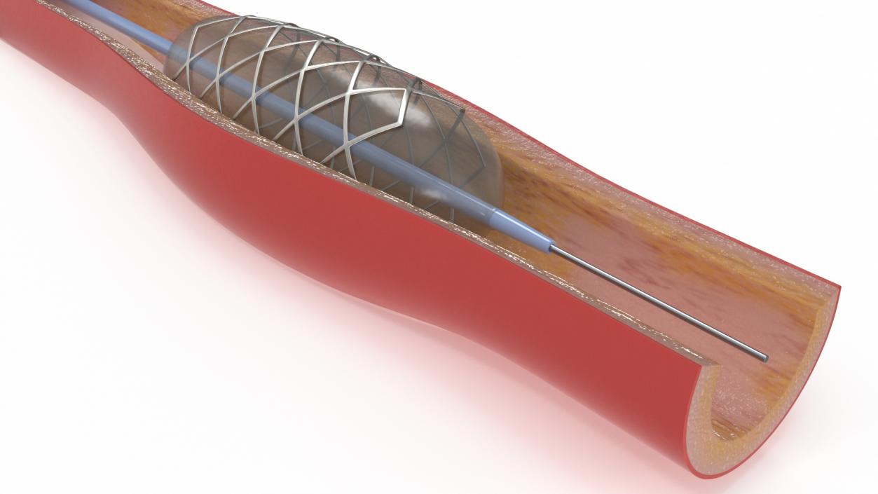 3D model Stents with Artery 2