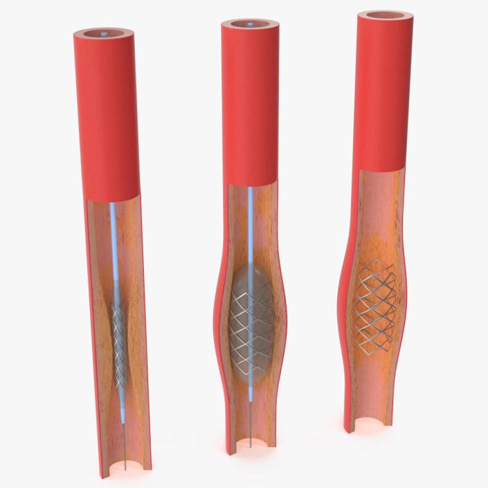 3D model Stents with Artery 2