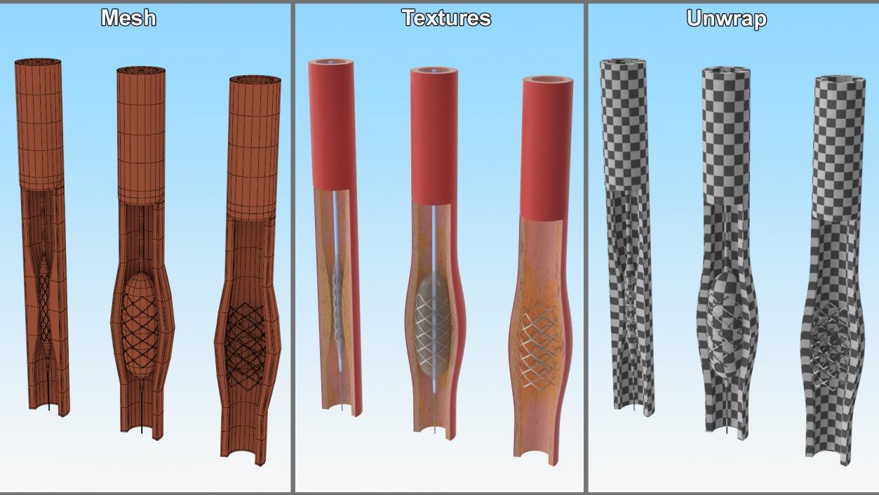 3D model Stents with Artery 2