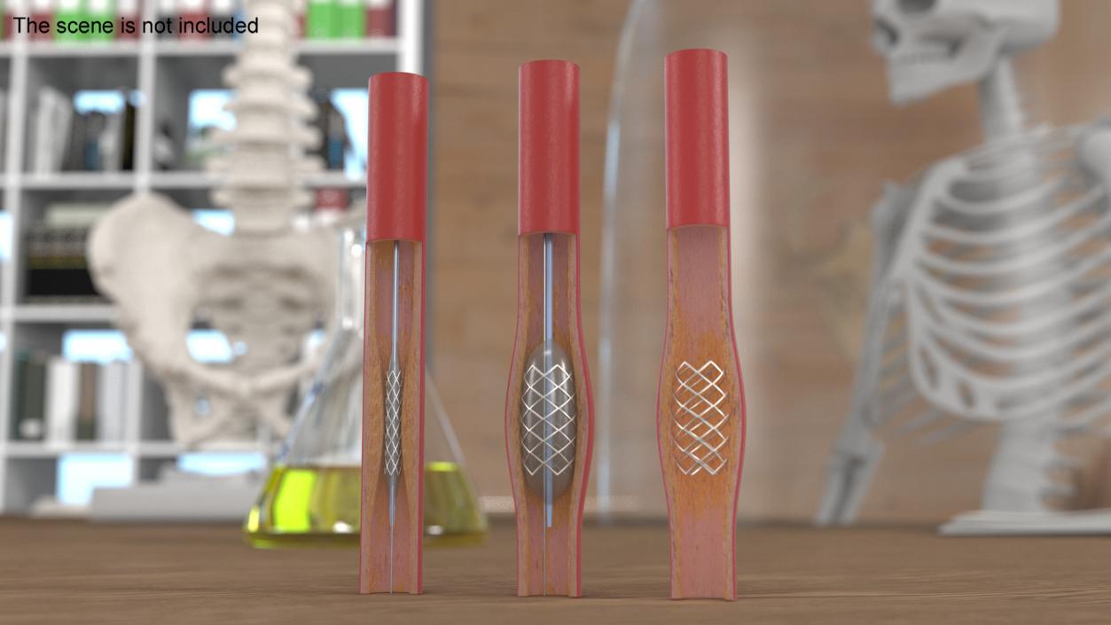 3D model Stents with Artery 2