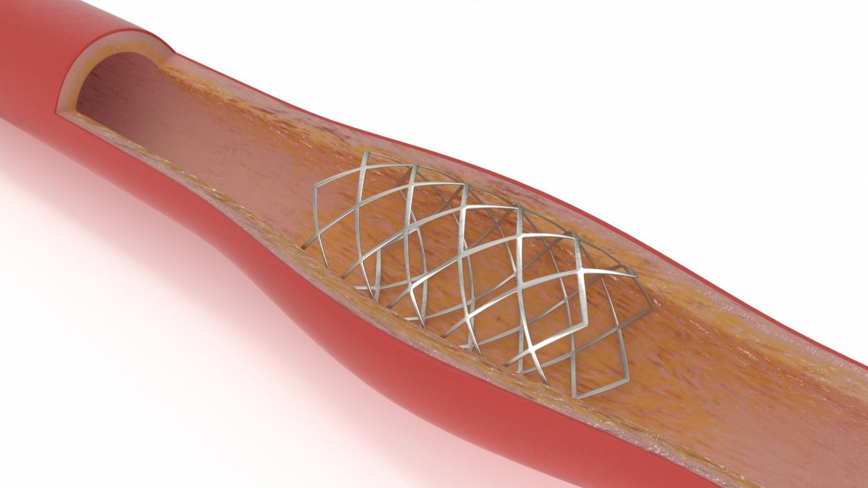 3D model Stents with Artery 2